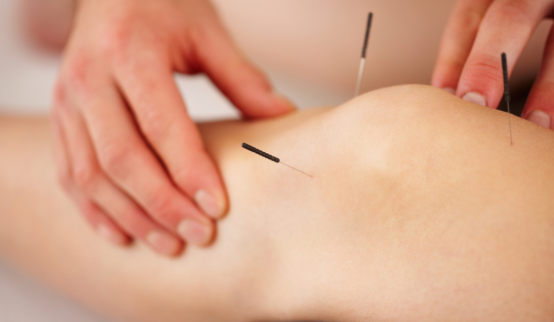 Is Acupuncture Treatment Right for You
