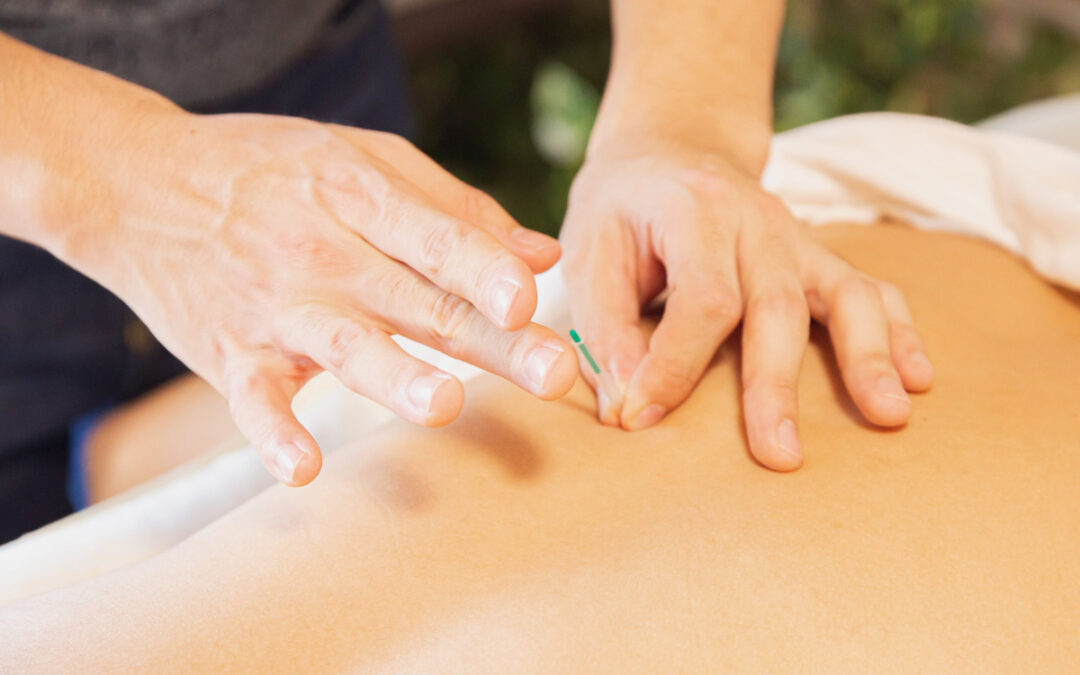 The Healing Art of Acupuncture: A Timeless Approach to Wellness